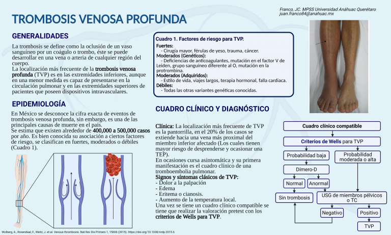 Trombosis venosa profunda, lo que tienes que saber – Escuela Ciencias